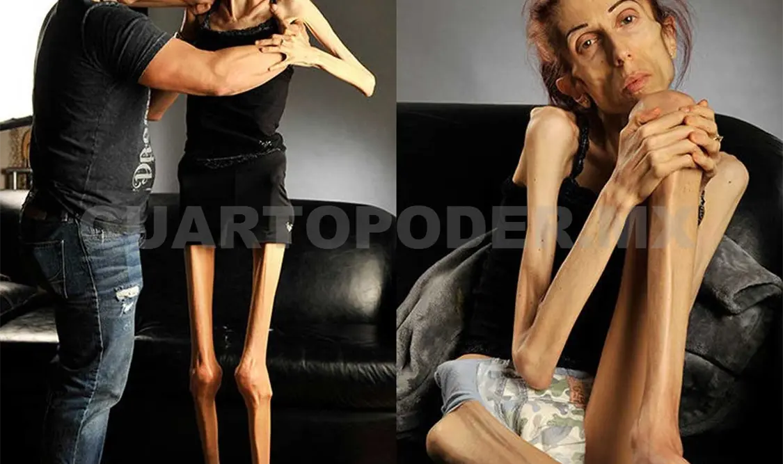 Pide que la salven de la anorexia