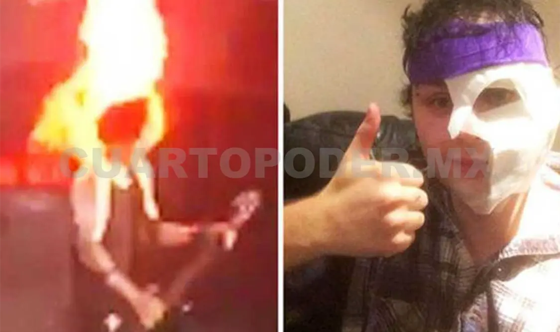 Guitarrista de 5 Seconds se quema el rostro