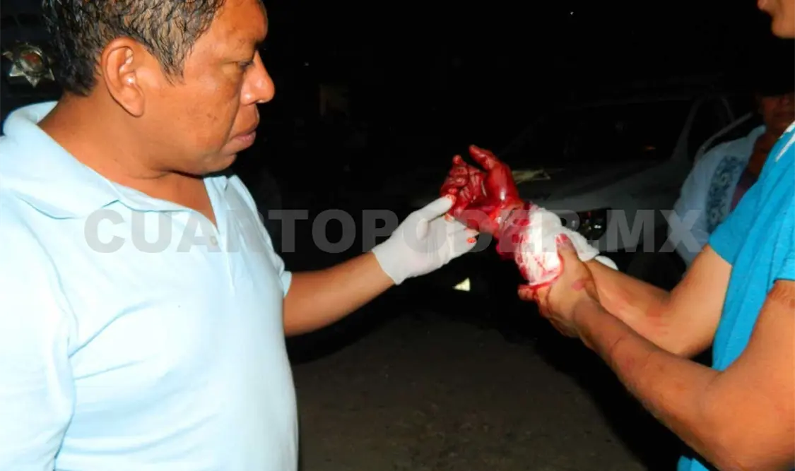 El transeúnte fue herido en la mano derecha al oponerse al asalto. A. Alegría / CP