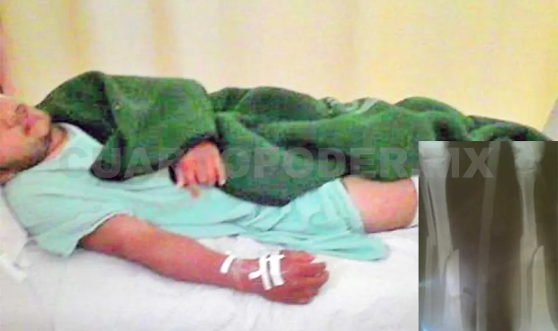 Fracturado, tras ser atropellado