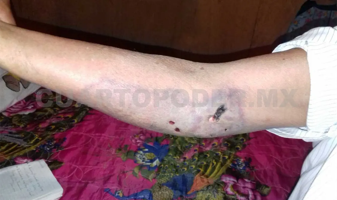 Octogenario sufrió picadura de araña