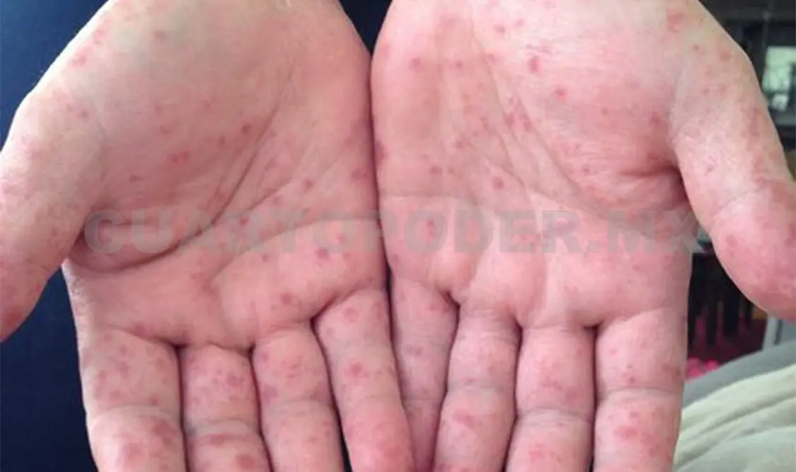 Alertan por presencia de virus que afecta a niños