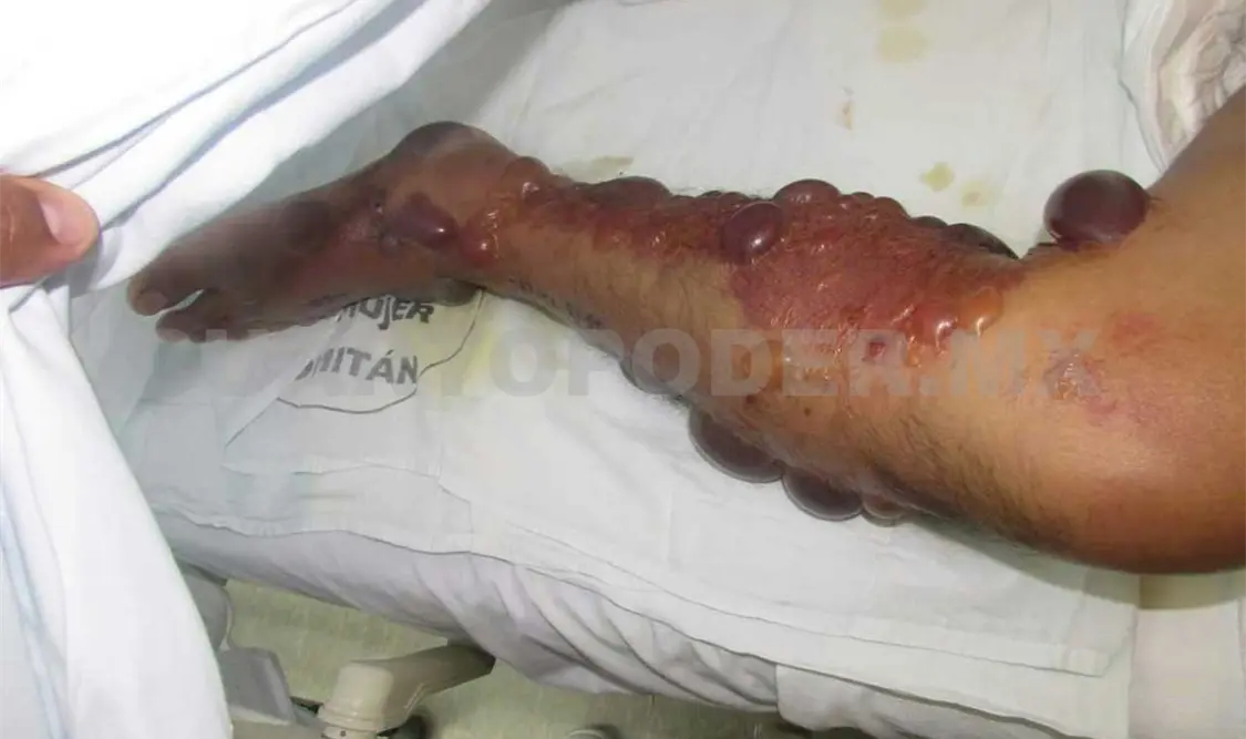 Sobrevive hombre a la mordida de una Nauyaca