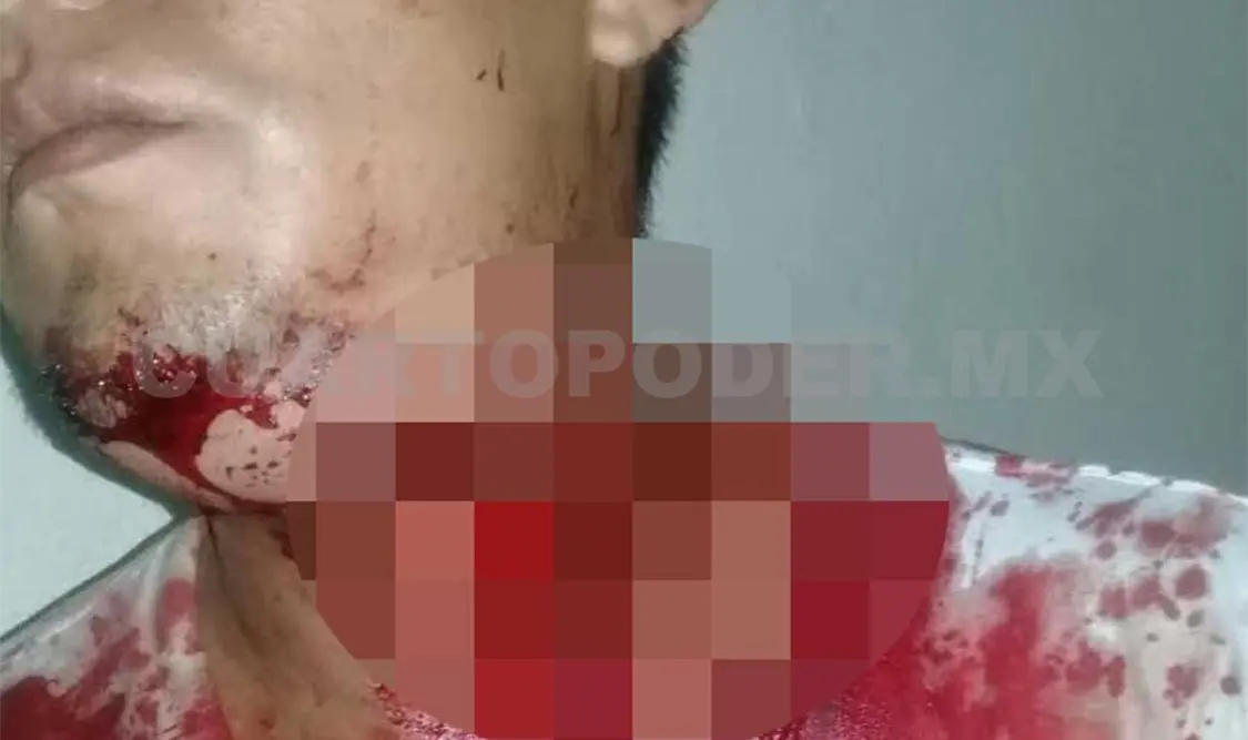 José Luis Tovar Rodas resultó con un impacto con arma de fuego a la altura del cuello y fue trasladado a un hospital. Rafael Victorio / CP