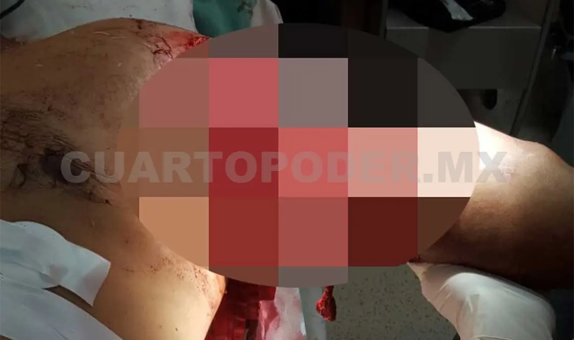 El brazo izquierdo no pudo ser rescatado por los médicos. Avisaín Alegría / CP