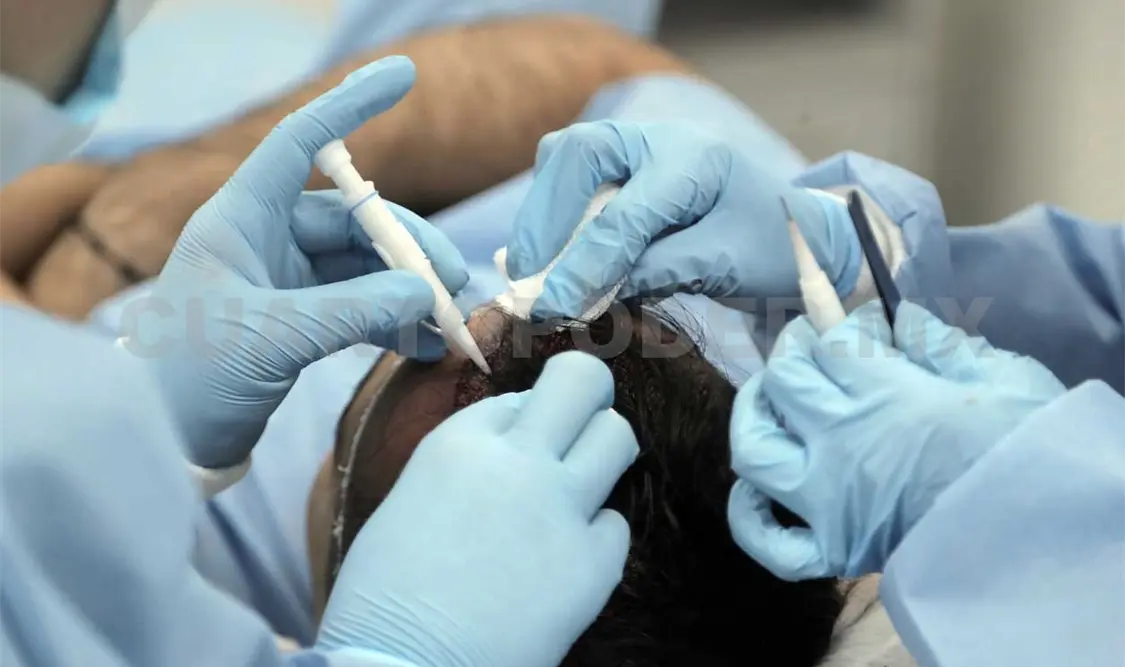 El boom de los implantes capilares