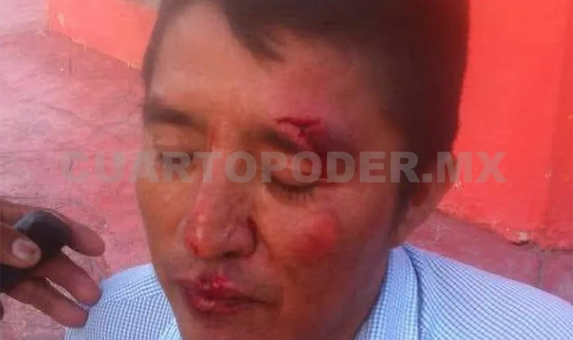 Con heridas en el rostro, golpes y excoriaciones en diferentes partes del cuerpo resultó Inmer Díaz Robledo al ser atropellado. Noel Vázquez / CP