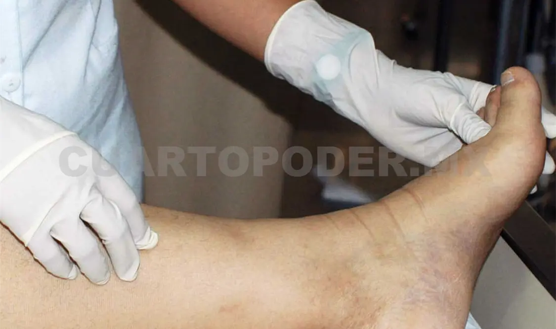 Los ambientes de humedad y calor son propicios para el desarrollo de micosis. CP