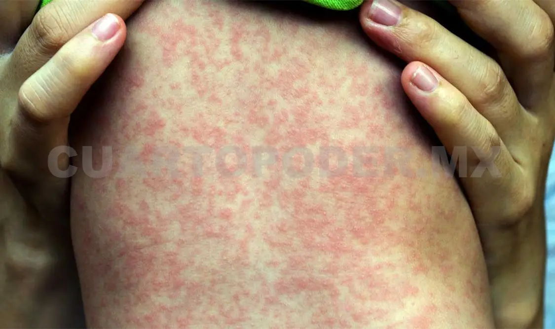 Alertan sobre sarampión en México