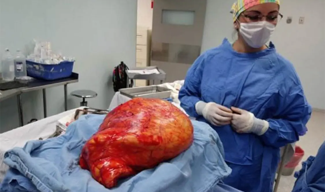 Extirpan tumor de 17 kilos a una mujer en Durango
