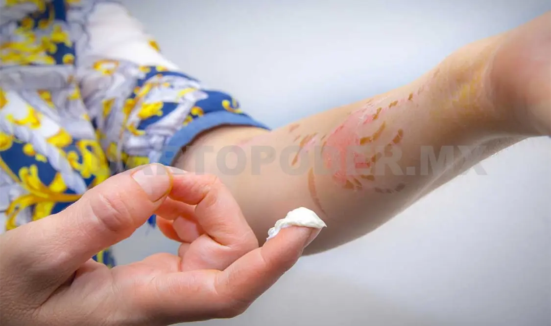 Las quemaduras de segundo y tercer grados deben ser valoradas de forma inmediata. CP