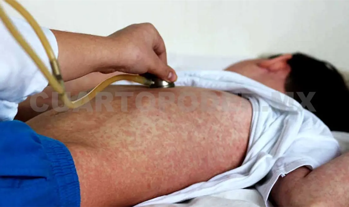 Confirman 12 casos de sarampión en 4 estados