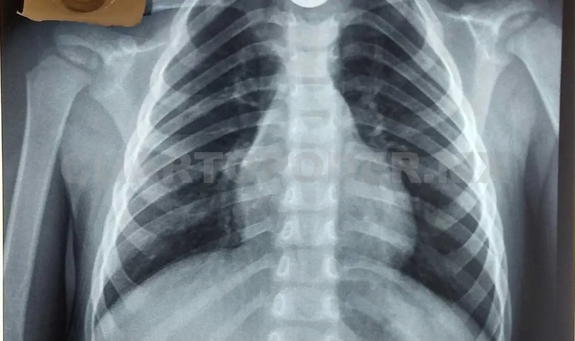 Peligroso que niños deglutan cuerpos extraños