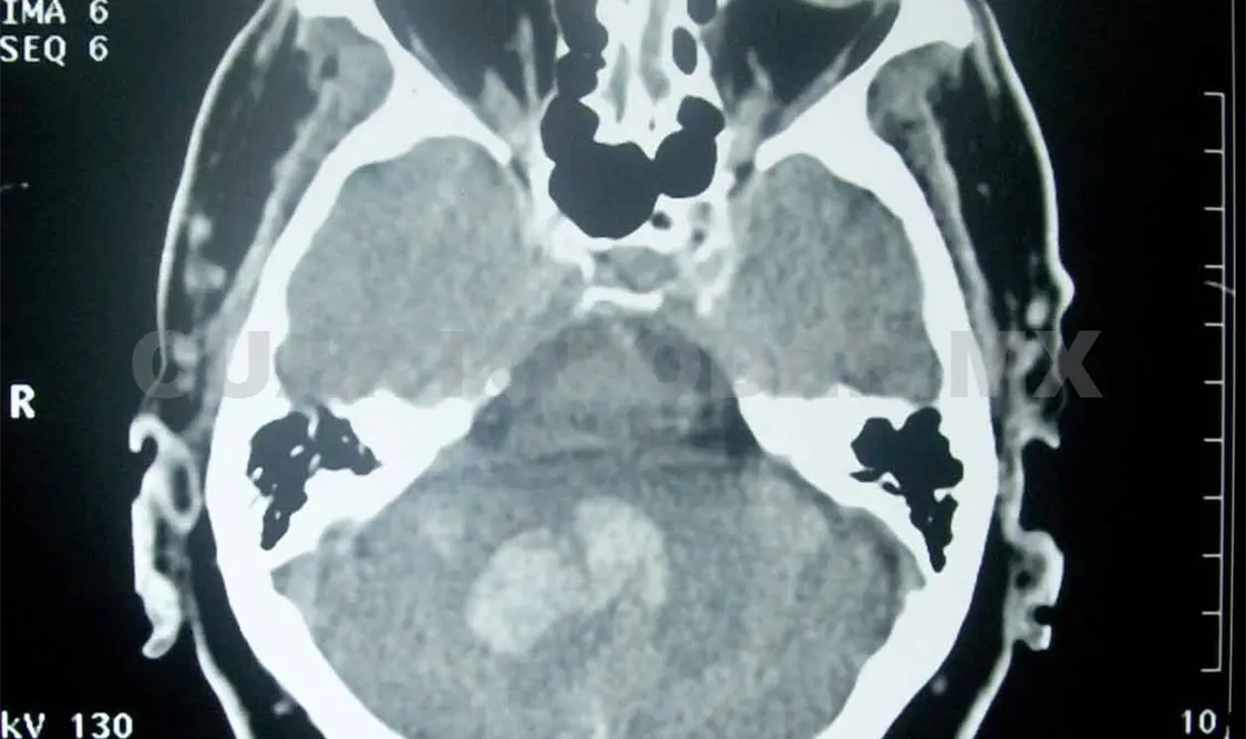 Necesario atender síntomas de EVC