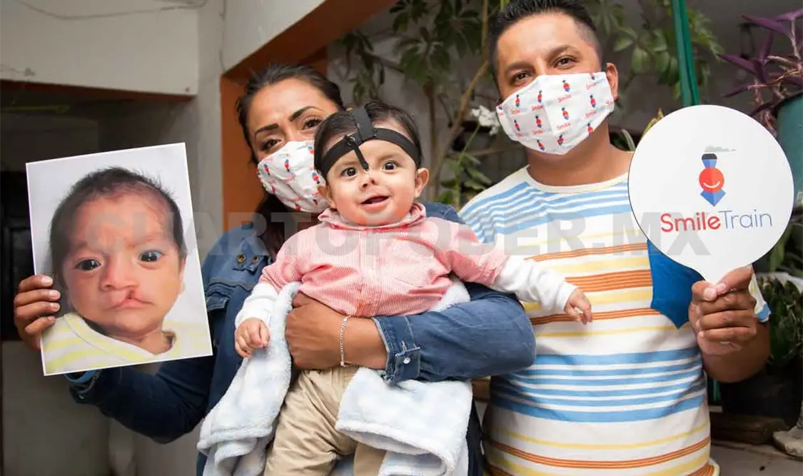 Smile Train realizará cirugías de palatoplastia