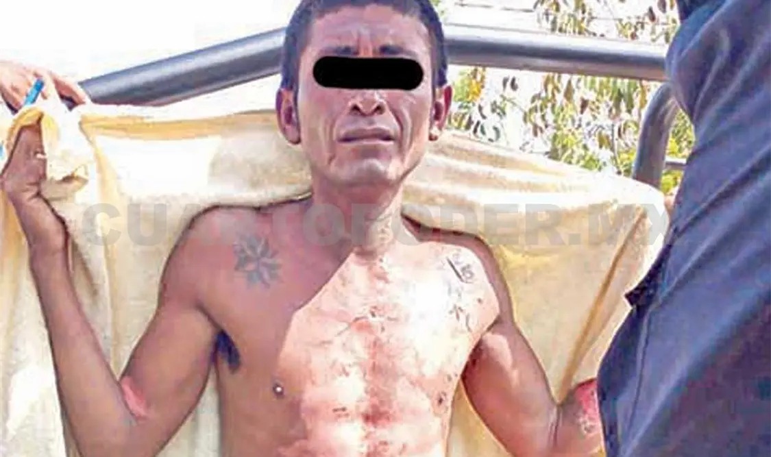 Debido a las quemaduras que presentaba en diferentes partes del cuerpo, fue llevado a un hospital. Cortesía