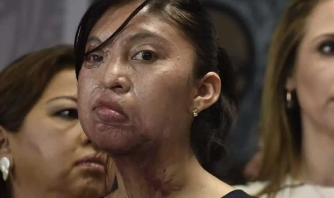 Desde 2001 se han presentado las denuncias de 26 mujeres que han sido atacadas por ácido. Cortesía