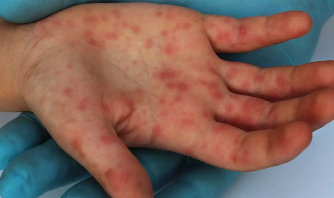 La viruela símica es un padecimiento infeccioso transmitido por contacto prolongado y de muy baja letalidad. Cortesía