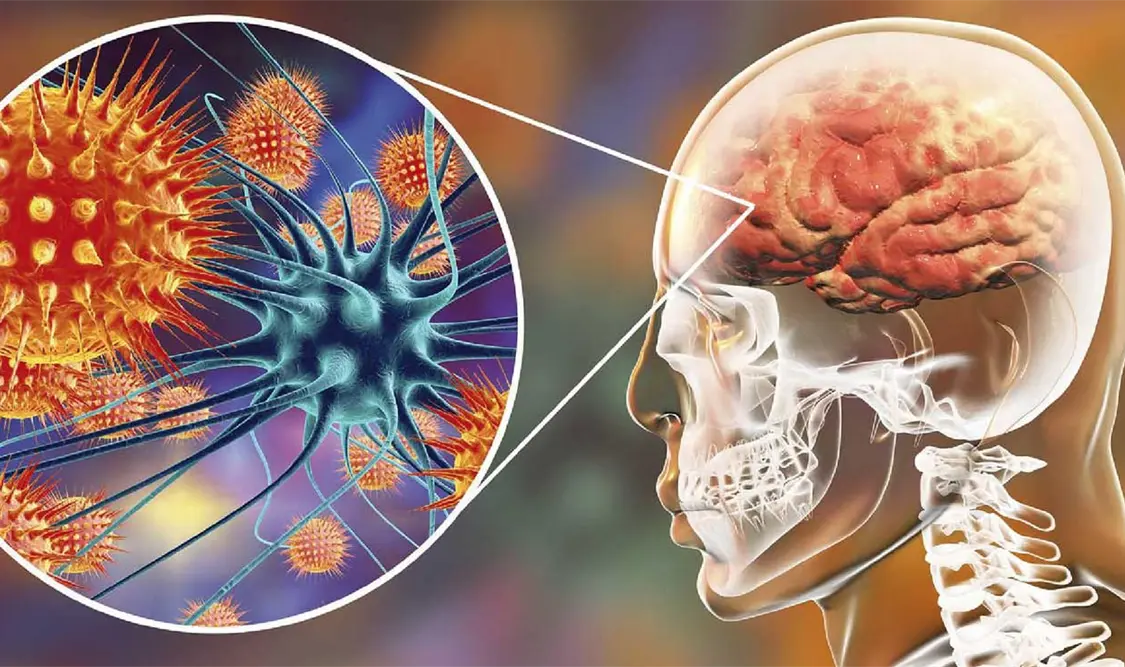 La meningitis inflama los tejidos que cubren el cerebro y la médula espinal. Cortesía