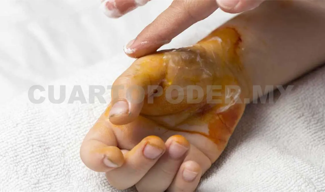 Aumentan casos de menores quemados