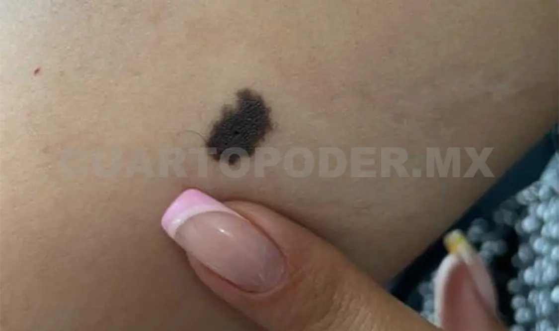 Llaman a prevenir la aparición de posibles melanomas