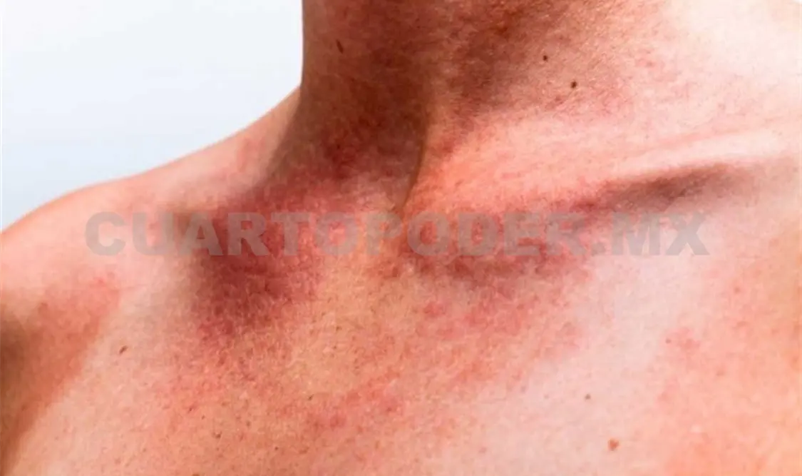 El sol ocasiona problemas serios en la piel: especialista