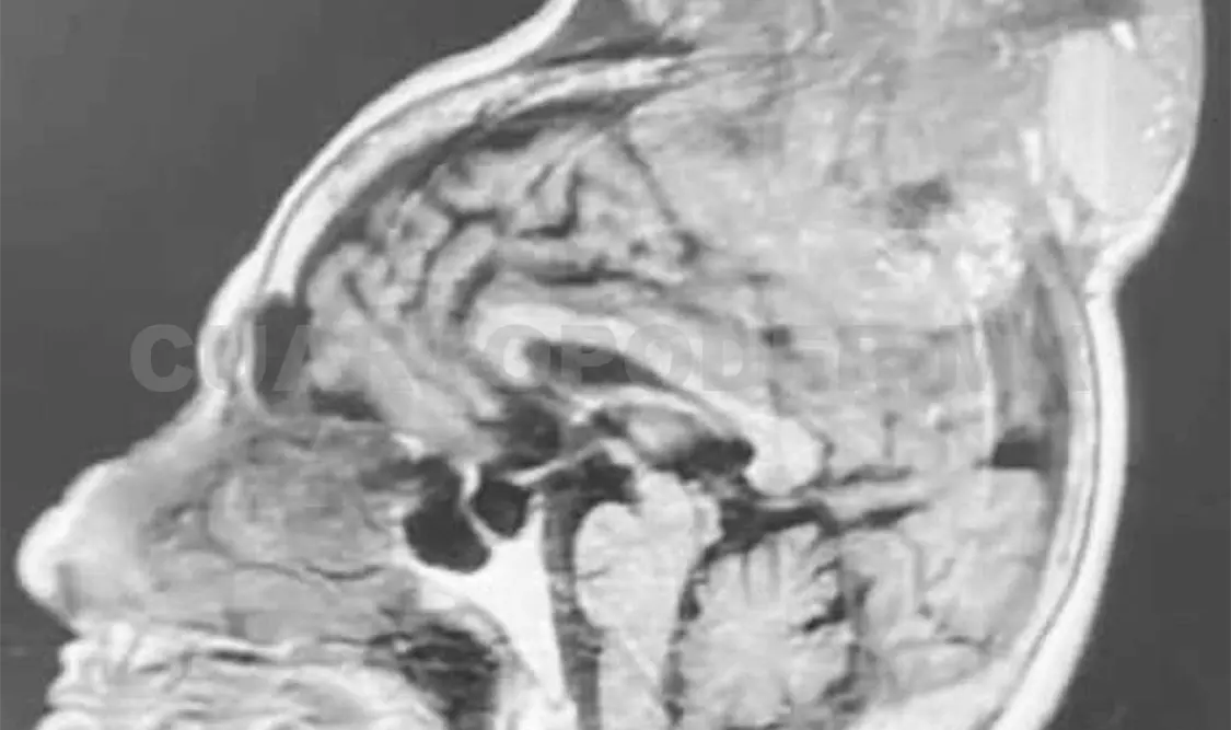 Retiran tumor de 20 cm a adulta mayor