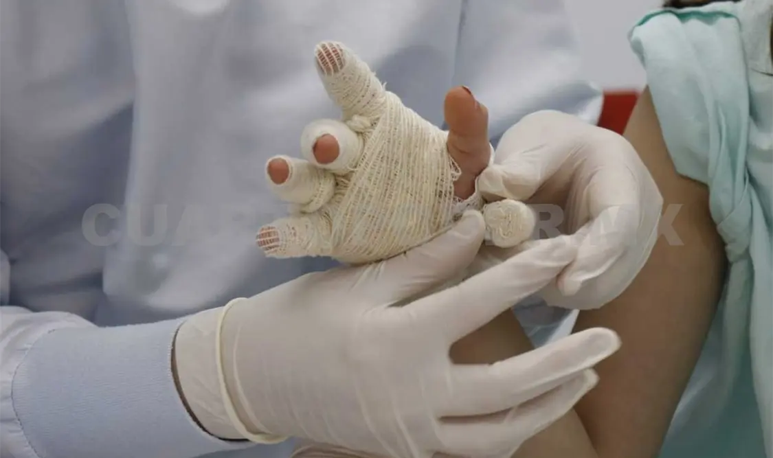 En septiembre también hay casos de quemaduras con líquidos hirviendo, refirió la delegada de la fundación. Diego Pérez / CP