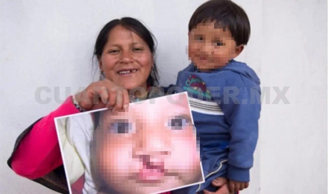 Atenderán a pacientes con labio y paladar hendido