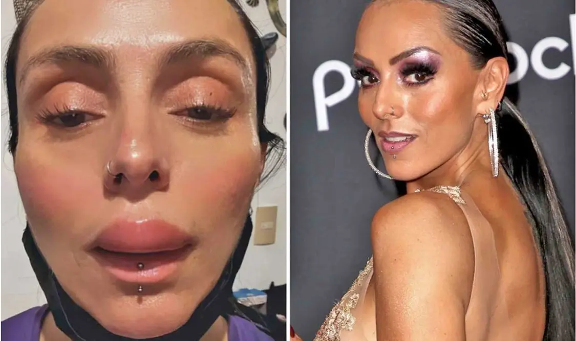 A Ivonne Montero se le hincharon los labios