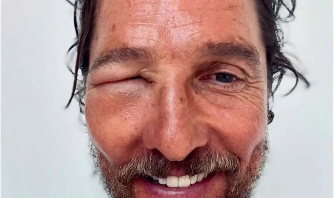Matthew McConaughey aparece hinchado