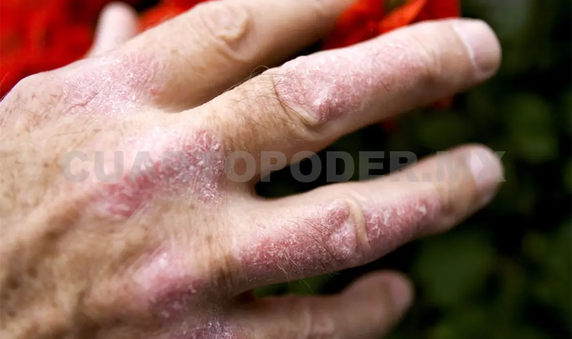 Cambios en el clima también afectan la piel