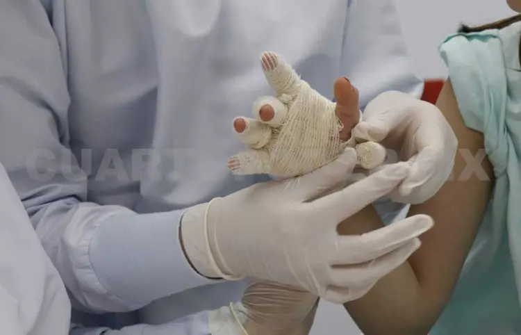 Nueve traslados de niños  quemados durante 2024
