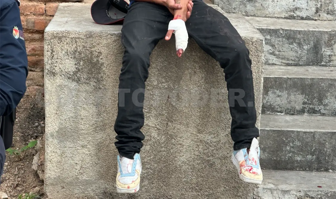 De una mordida pierde parte de un dedo