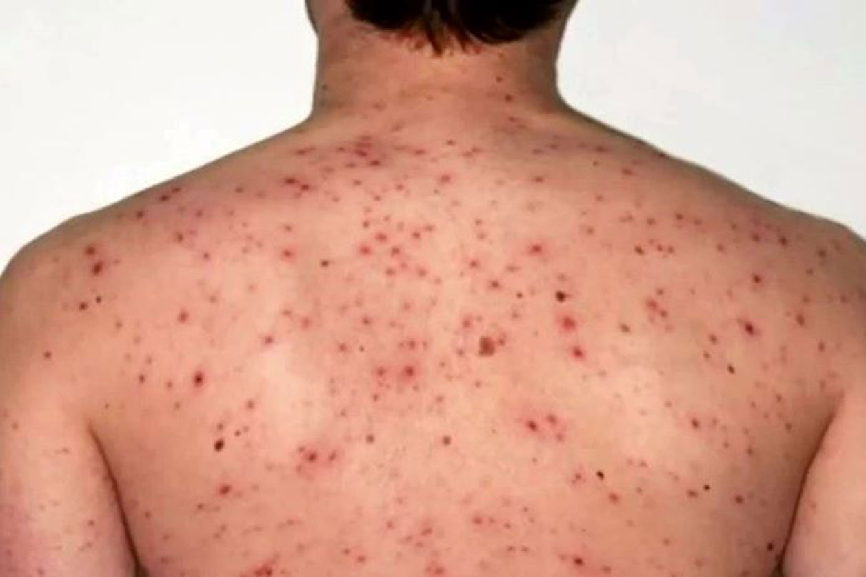 Llega a NL primer caso importado de sarampión