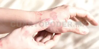 Radiación de pantallas también afecta la piel