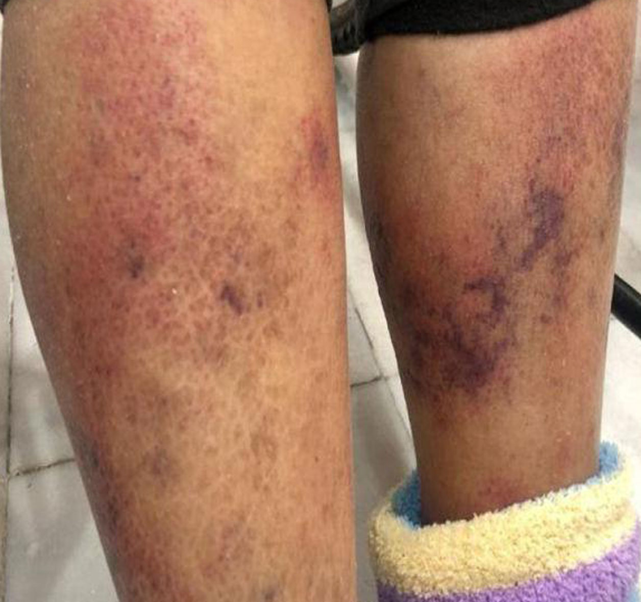 Suman 8 muertos por bacteria carnívora