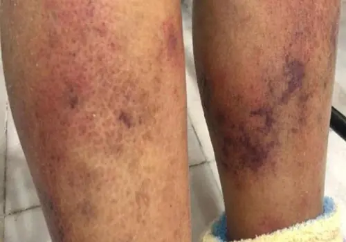 Suman 8 muertos por bacteria carnívora