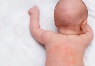 Afectaciones frecuentes en el cuello del bebé Afectaciones frecuentes en el cuello del bebé