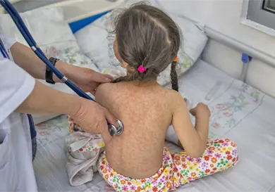 Van 74 casos de sarampión activos en nueve estados Van 74 casos de sarampión activos en nueve estados