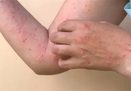 Confirma Ssa 78 nuevos casos de sarampión