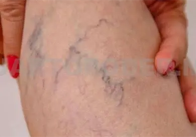 Realizan campaña contra varices