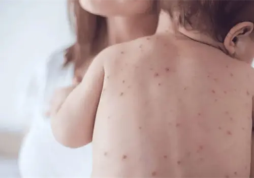 Cómo prevenir el sarampión Cómo prevenir el sarampión