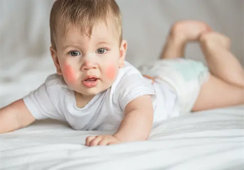 Dermatitis atópica en bebés Dermatitis atópica en bebés