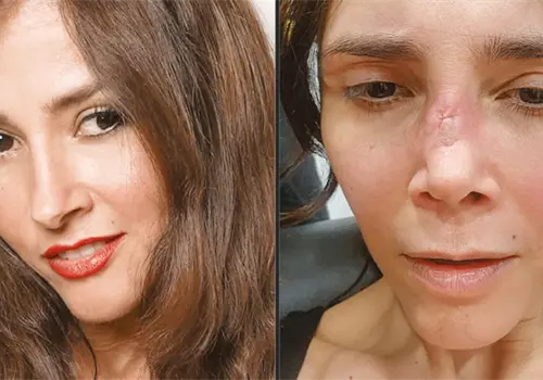 Revela c&oacute;mo qued&oacute; su "nueva nariz"