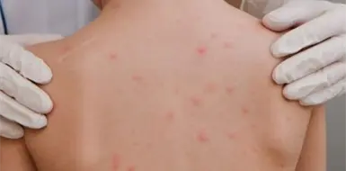 Se aceleran contagios de sarampión en Tabasco Se aceleran contagios de sarampión en Tabasco