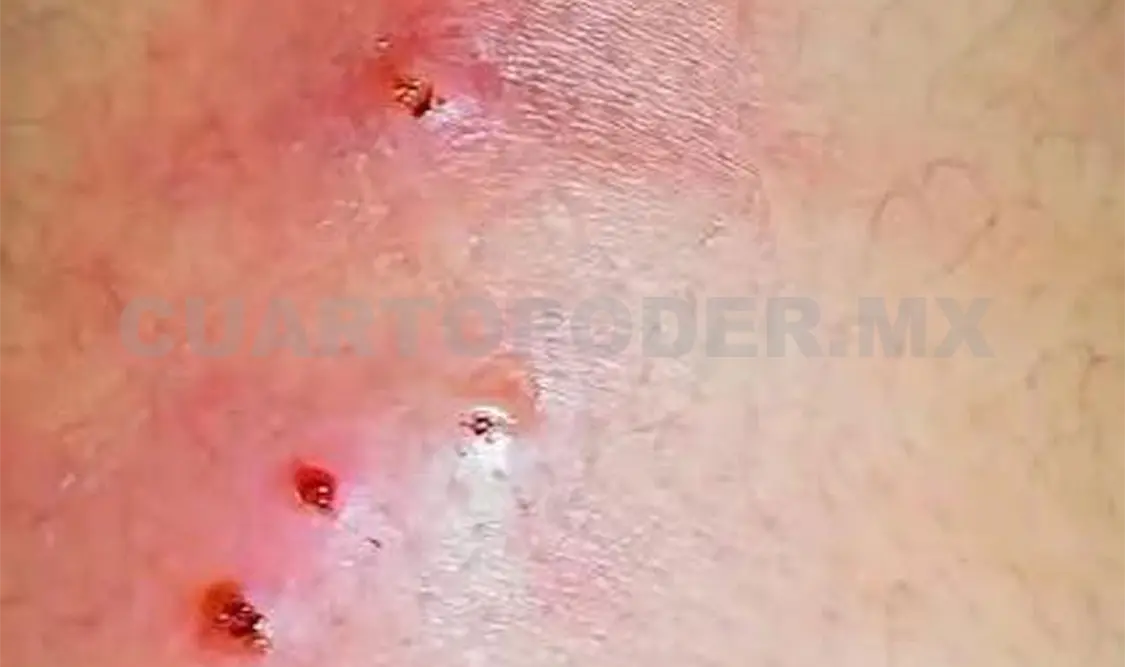 Recomiendan a la población cuidar las heridas abiertas. Rafael Victorio / CP