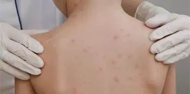 Se aceleran los contagios de sarampi&oacute;n; van 38