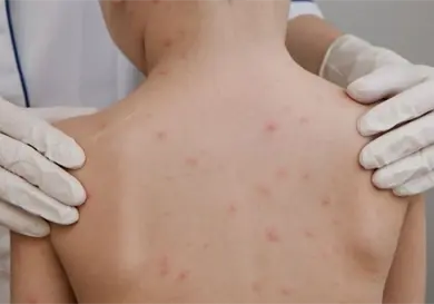 Se aceleran los contagios de sarampi&oacute;n; van 38