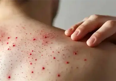 Suman 40 las muertes causadas por sarampi&oacute;n